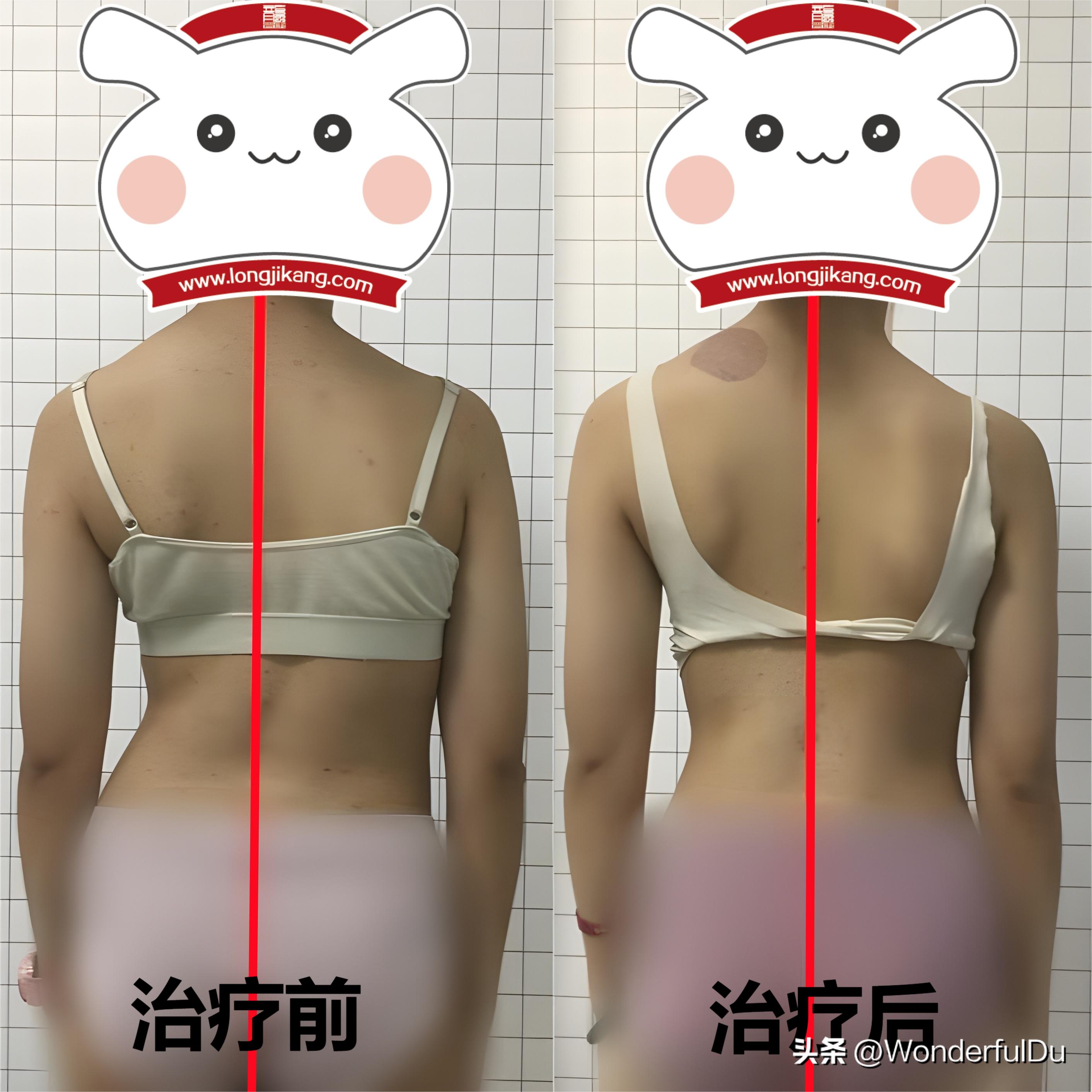 脊柱侧弯40度戴支具能正过来吗,s弯脊柱侧弯40度要手术吗