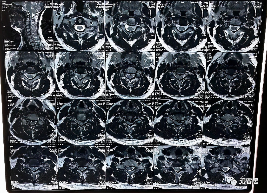 颈椎突出并椎管狭窄能正骨吗,颈椎间盘突出无症状