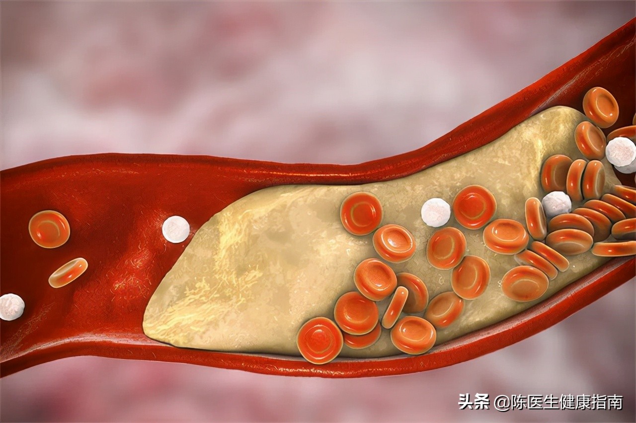 进口他汀比国产的副作用要小点吗,进口他汀太贵怎么办