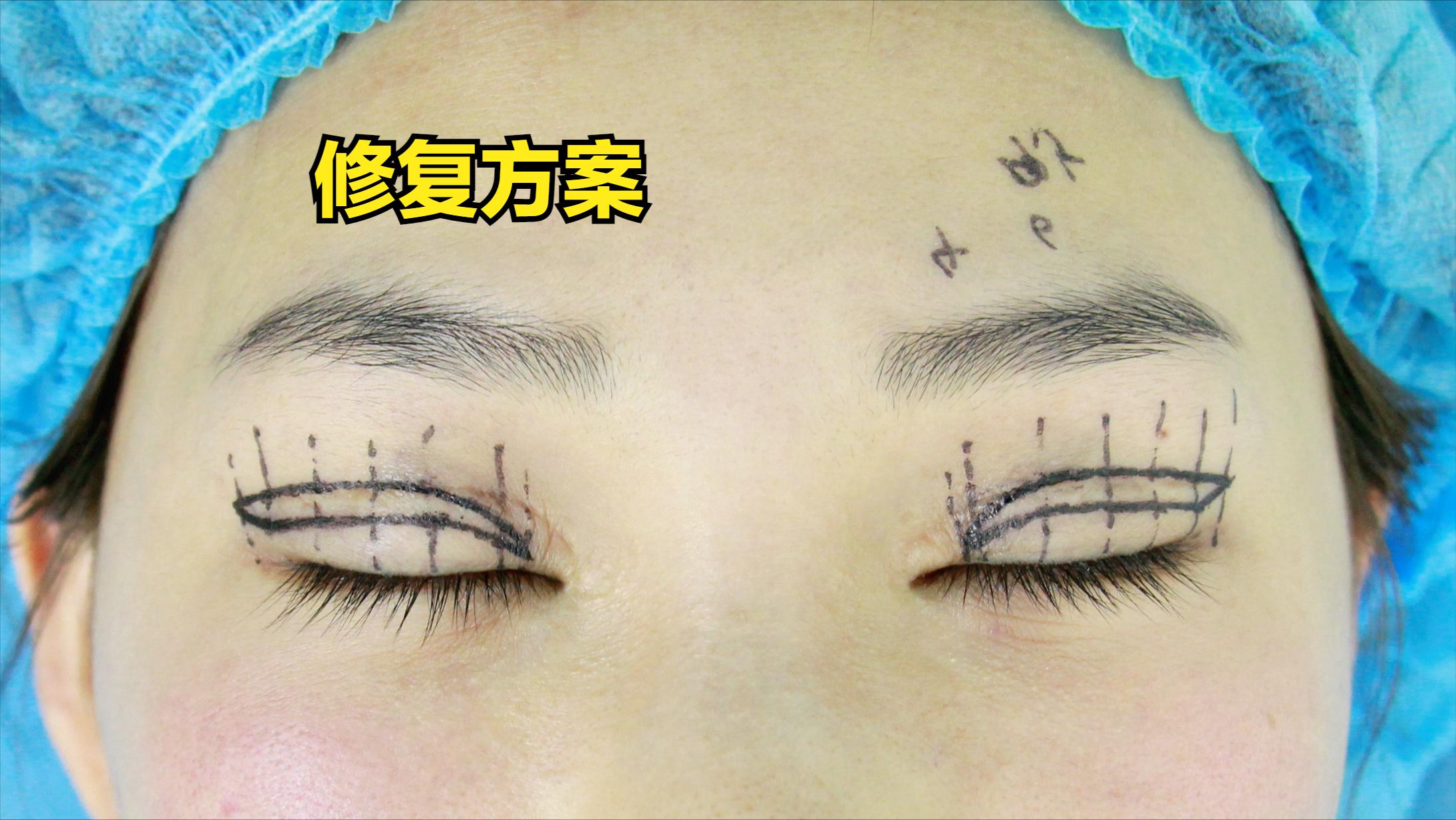 双眼皮做宽了眼尾有点上不去,双眼皮做宽了难看