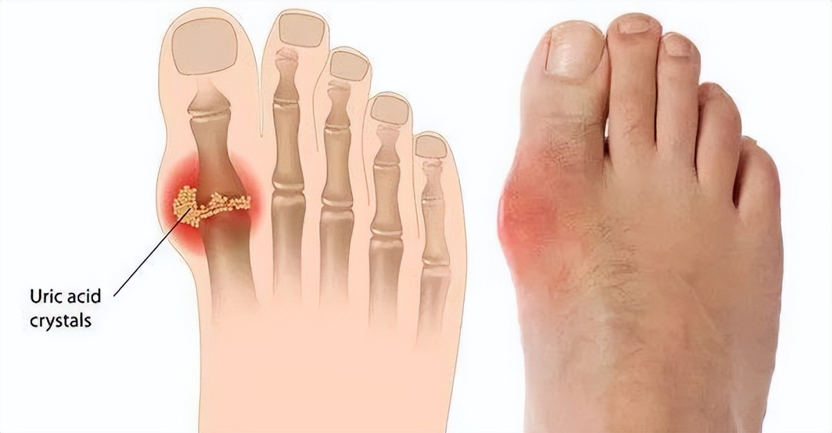 痛风高尿酸患者要少吃这些红肉,高尿酸和痛风的人必须要吃什么