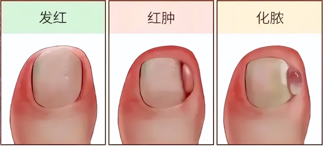 脚趾甲老往肉里钻，一碰还疼？教你小妙招，预防甲沟炎告别疼痛