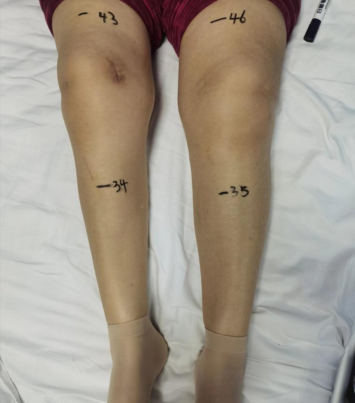 双下肢横纹肌肉溶解症,下肢肿胀鉴别诊断