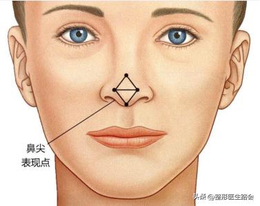隆鼻恢复后鼻头会往下走吗,隆鼻后鼻头不对称怎么修复