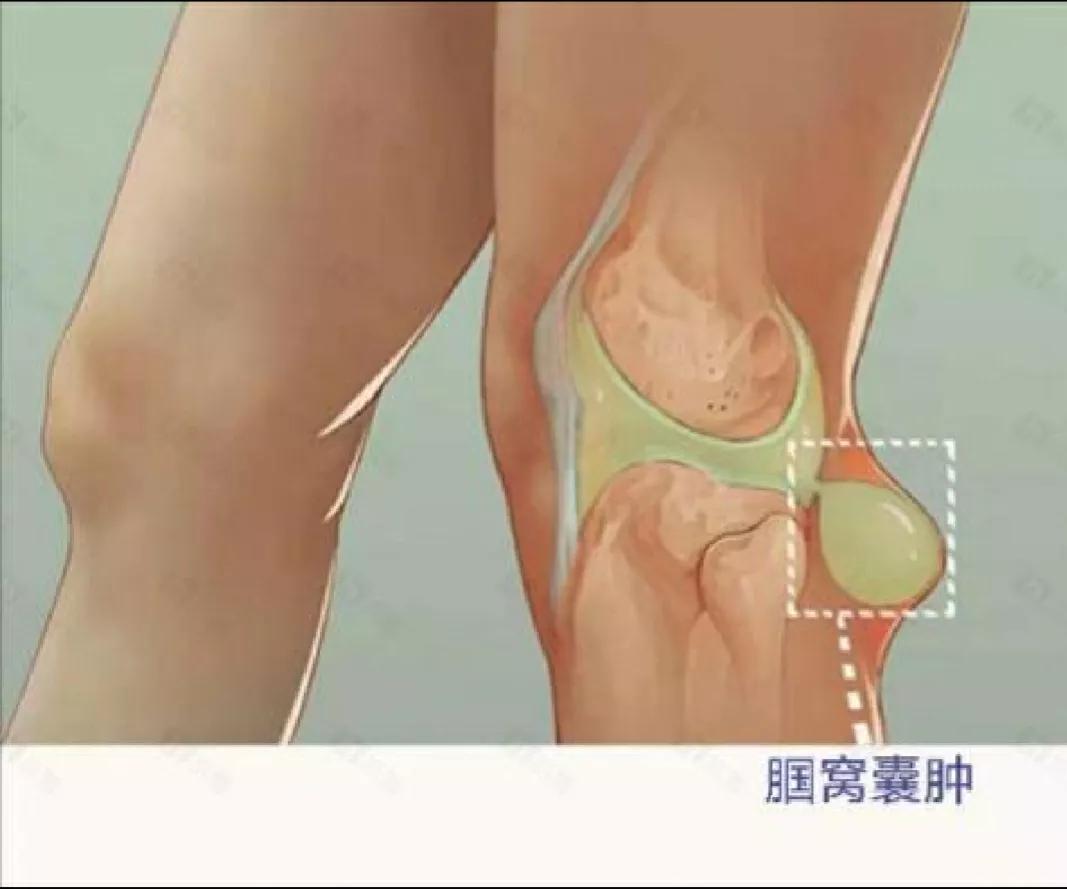 女老板割腘窝囊肿，却查出了早期肺癌，医生：真是个救命的囊肿