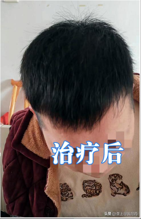 一根、两根、三四根，小伙“秃”然慌了