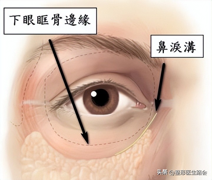40岁泪沟用什么填充最好,40岁眼袋泪沟最好的解决方法
