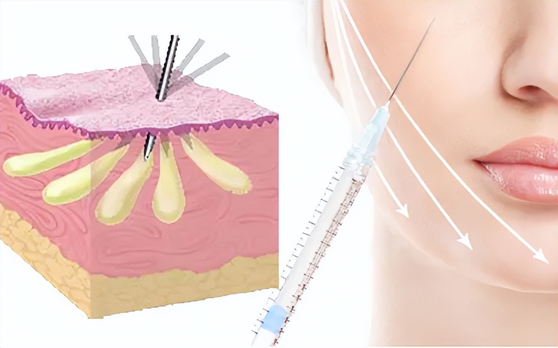 九院韦敏改脸型,九院填充太阳穴失败案例