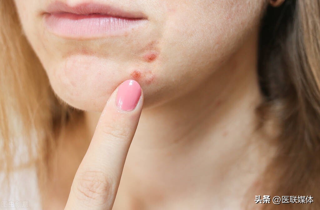 疮好了以后疮疤还经常痛痒怎么办,疮好了又复发怎么回事