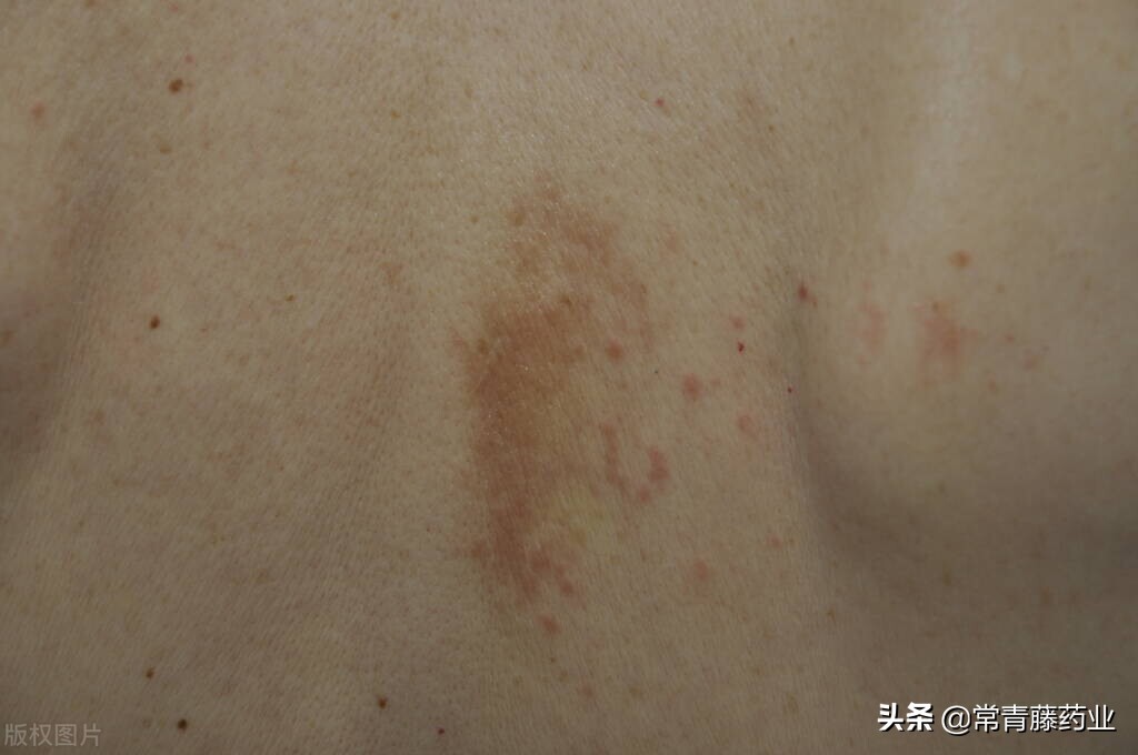 皮肤湿疹不痒了有红斑怎样消除,湿疹和死皮一样怎么治疗