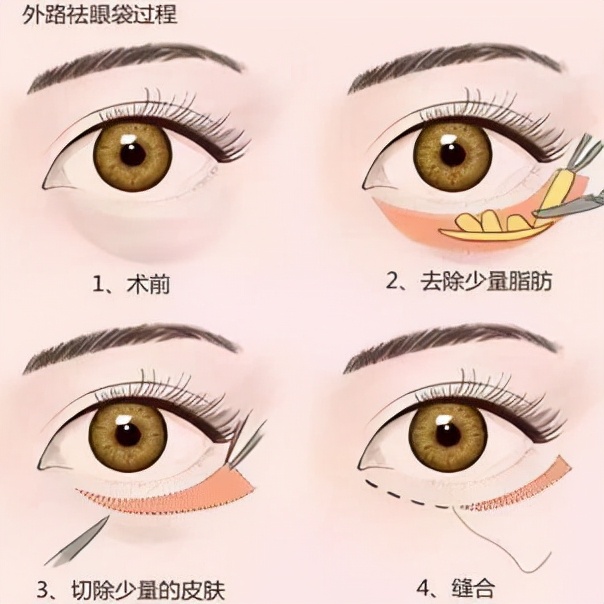 微整切眉去眼袋可以年轻多少岁,有几种快速去眼袋的方法