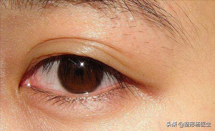 肿眼泡适合做埋线双眼皮吗,贴双眼皮贴还是肿眼泡可以埋线吗