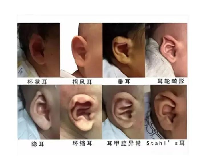 耳廓畸形矫正器戴法,耳廓畸形矫正器的安装办法