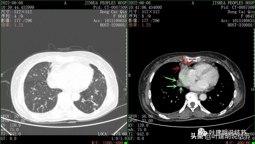 这位老乡，乏力来查，查出这么大个的纵隔肿瘤！会是什么呢？