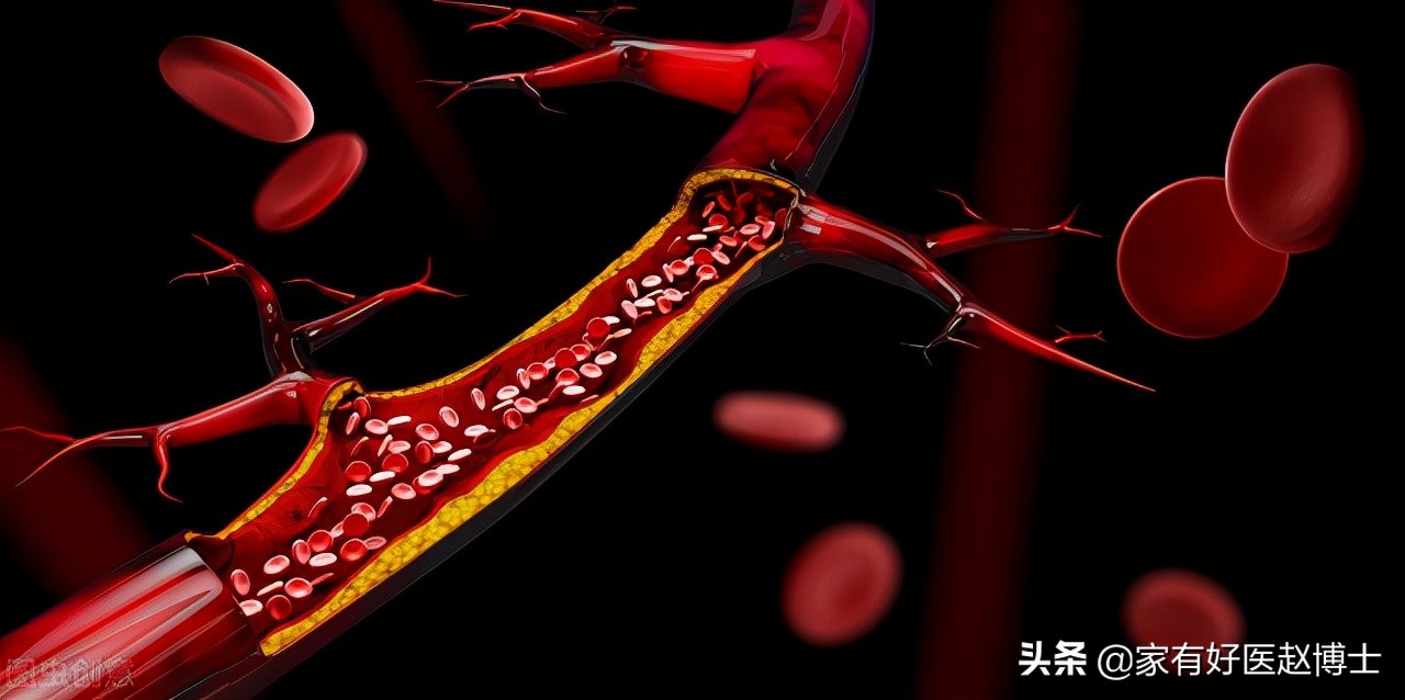 影响胆固醇的高低哪六项重要因素,胆固醇偏高的危害和预防