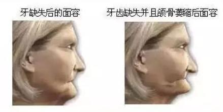 缺牙时间久镶牙位置不够怎么办,缺牙太久局部矫正