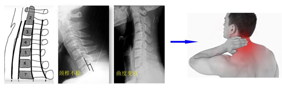 颈椎病是什么病要怎么治,颈椎病是怎样的症状