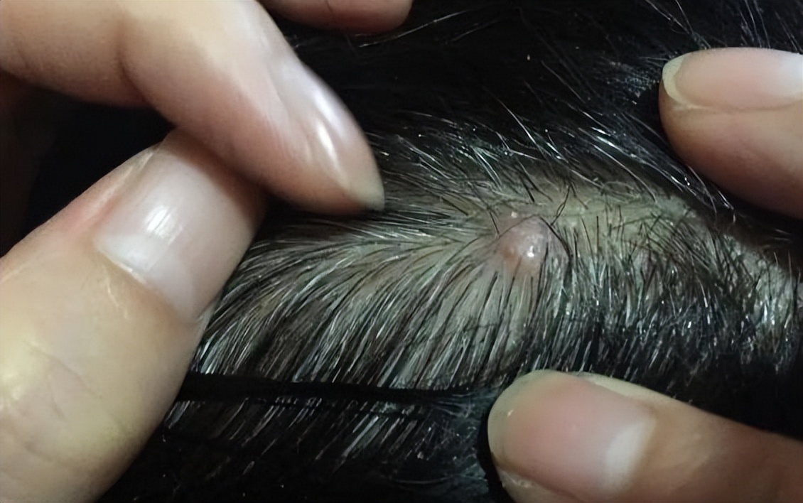 为什么头皮长痘痘和脓包,头皮上长小疙瘩脓包是怎么回事