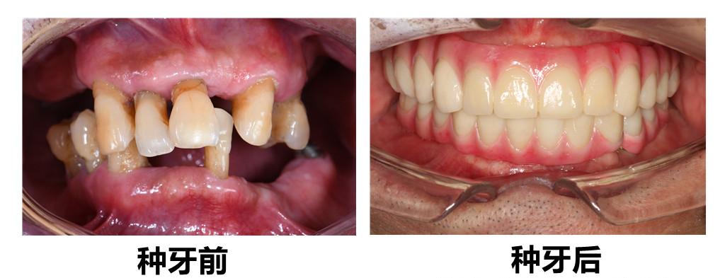 什么材质的假牙最好最耐用,十大顶级假牙