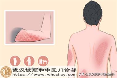 银屑病后背一小块怎么治,后背银屑病的症状