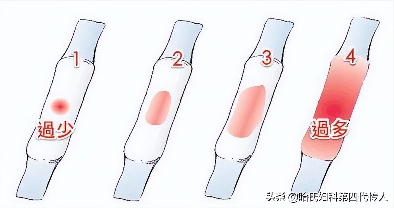 月经量少月经错后怎么治,月经量少经期后怎么调理