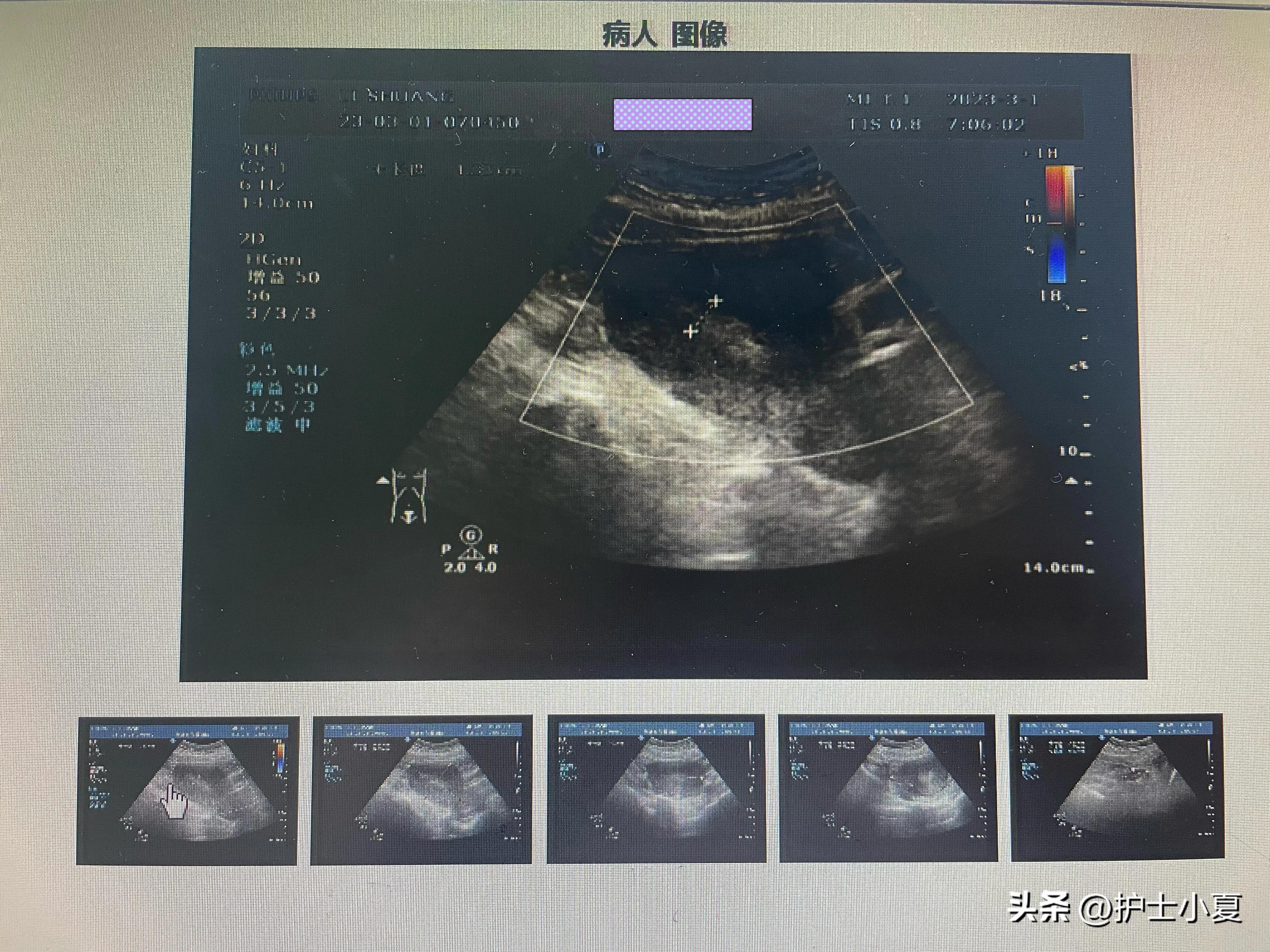 病例分享：25岁女孩，孕13周引产，引产后需要注意哪些？