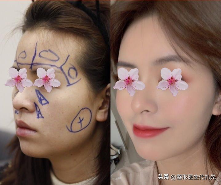 脸颊凹陷怎么改善最有效的方法,面颊衰老凹陷怎么改善