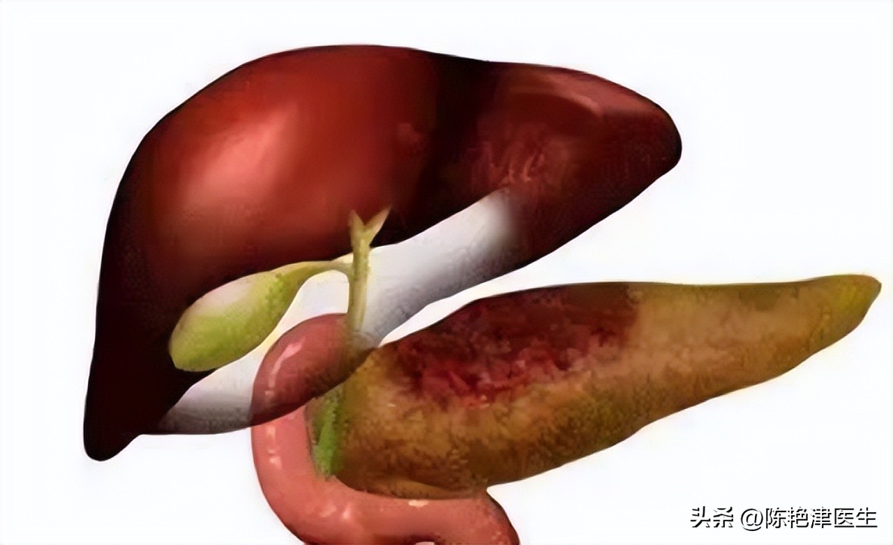 体检甘油三酯偏高是怎么解决,体检显示甘油三酯高是怎么回事