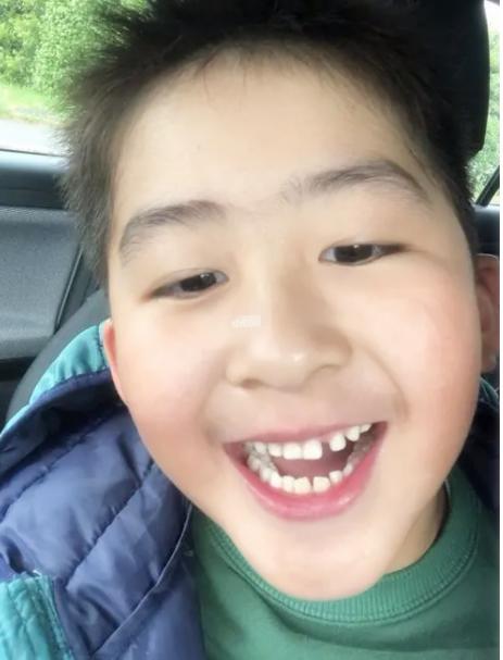 孩子上牙的牙缝特别宽要矫正吗,宝宝牙缝大换了牙齿会不会改善