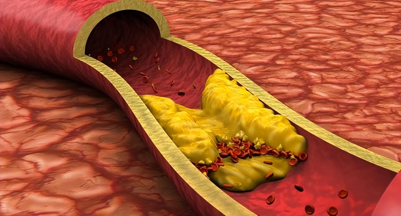 脑动脉硬化治疗多久能使症状缓解,如何缓解动脉硬化增加血管弹性