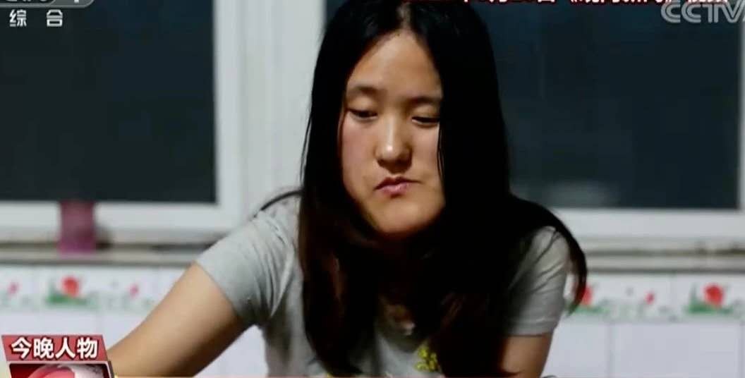 女孩因高烧毁容，后获郭明义帮助整形成功，高颜值引网红公司争抢