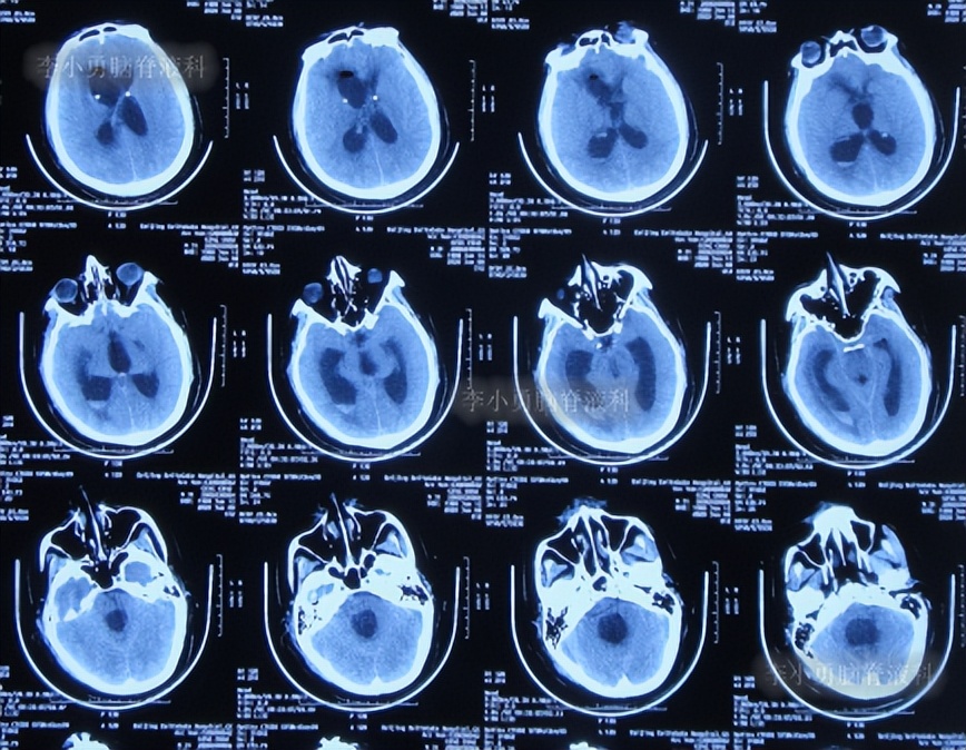 脑积水三脑室造瘘多久能恢复,脑囊虫手术后脑积水