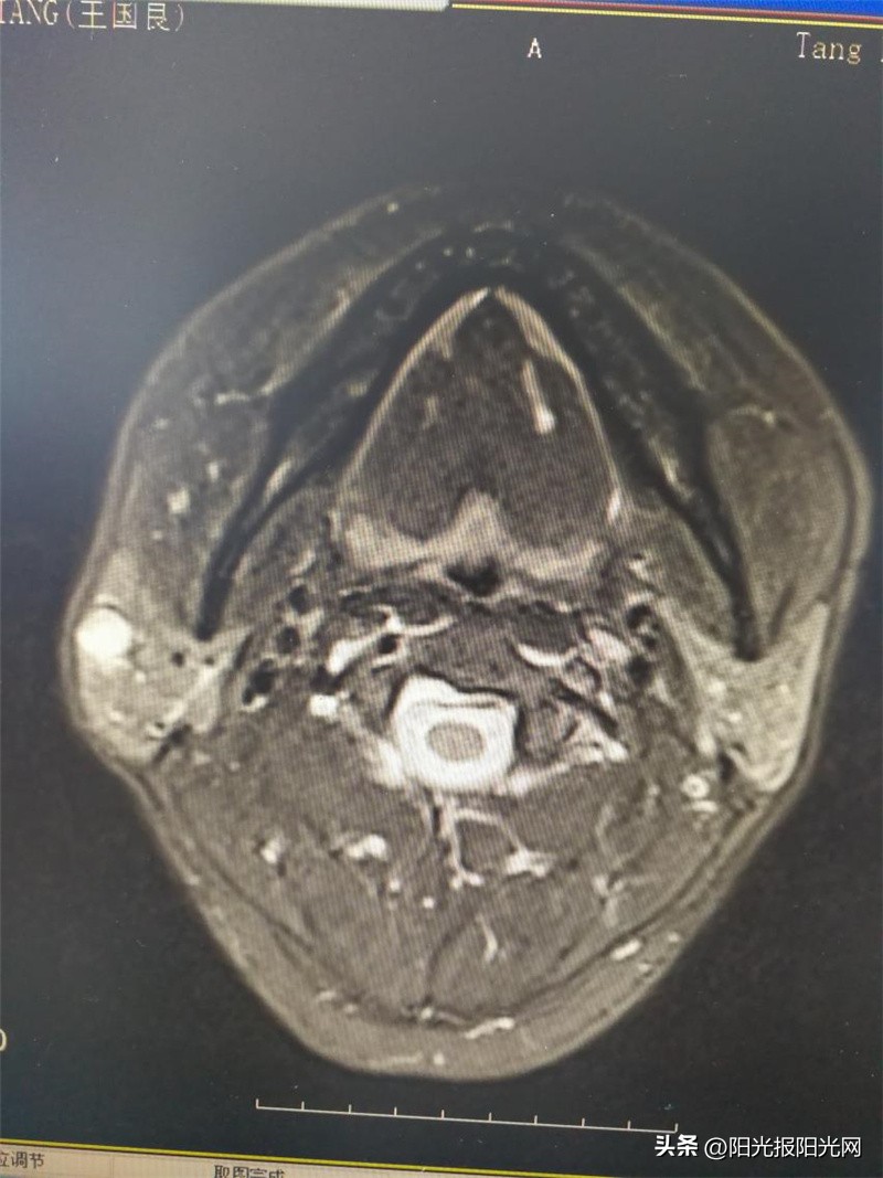 左侧腮腺肿瘤恶化,颈部腮腺疯狂长肿瘤
