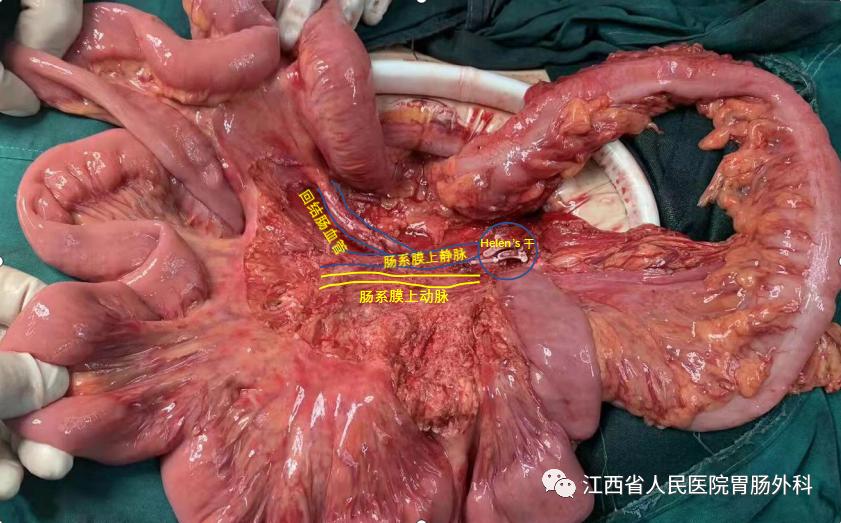 花季少女切除脏器,花季少女肚子肿瘤