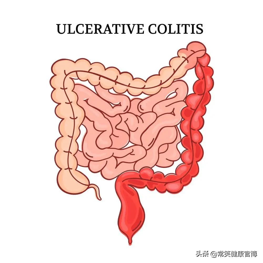 肛门有肿物脱出需要注意什么,肛门肿物脱出怎么治疗