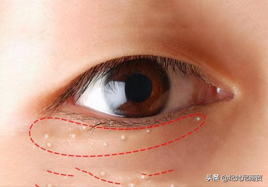 脖子上的脂肪粒消除最快方法,眼下面的脂肪粒怎么彻底消除