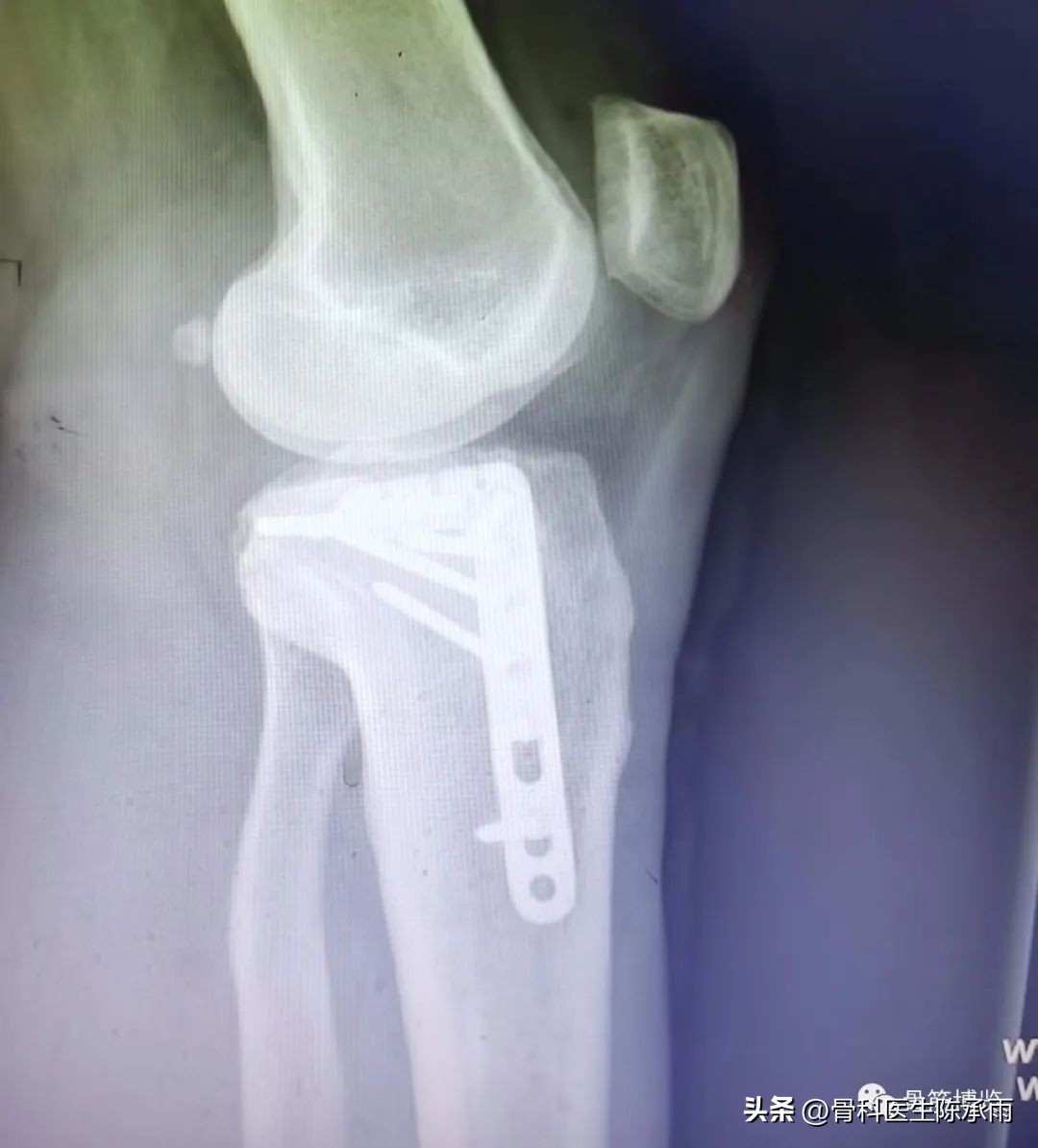 膝关节胫骨平台骨折,最近胫骨平台骨折视频