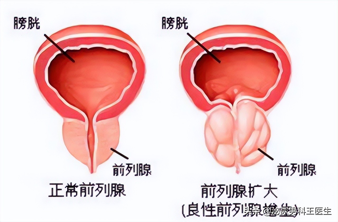 治疗前列腺增生最好的三种药,前列腺增生钙化吃什么药物有效