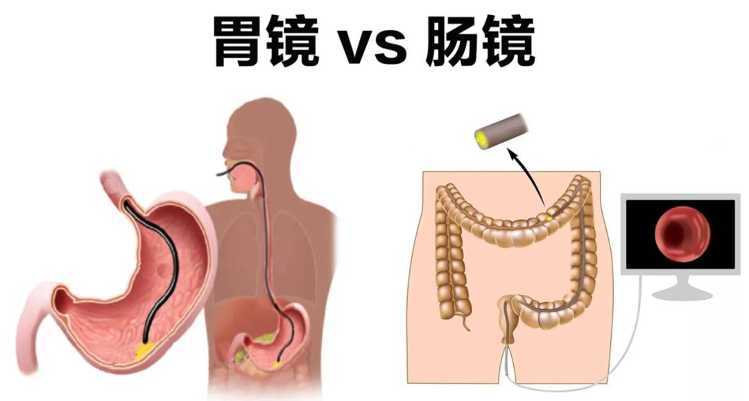 万万没想到，无意中做的胃肠镜，帮我捡回一条命