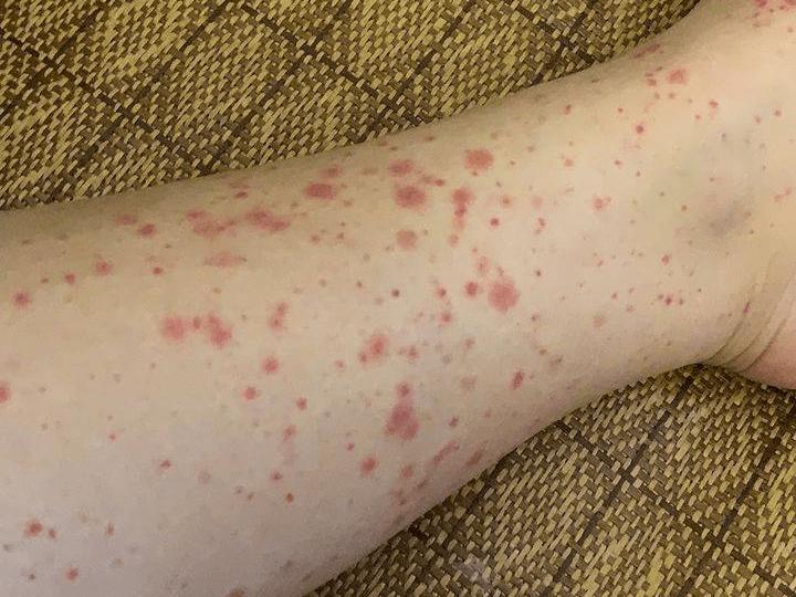 过敏性紫癜儿童怎么好得快,孩子得了过敏性紫癜该怎么办