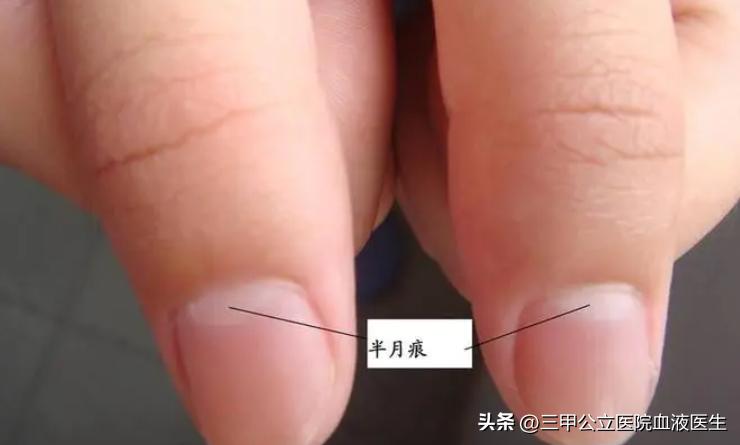 手指甲发白没有月牙有明显竖纹,手指甲有月牙和条纹是什么原因