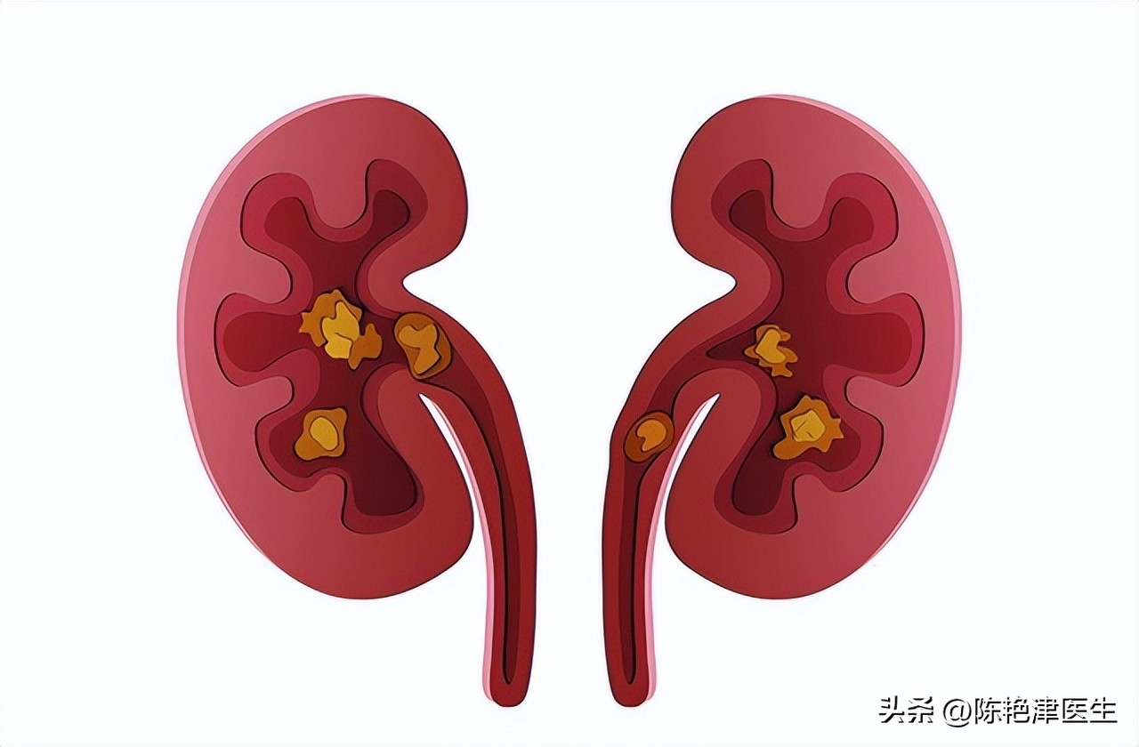 体检查出有肾结石要注意什么,体检有肾结石应该怎么处理