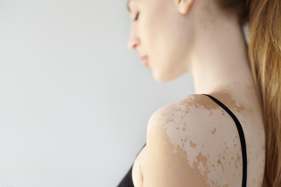 稳定期的白斑怎样快速复色,一般照几次白斑可以复色