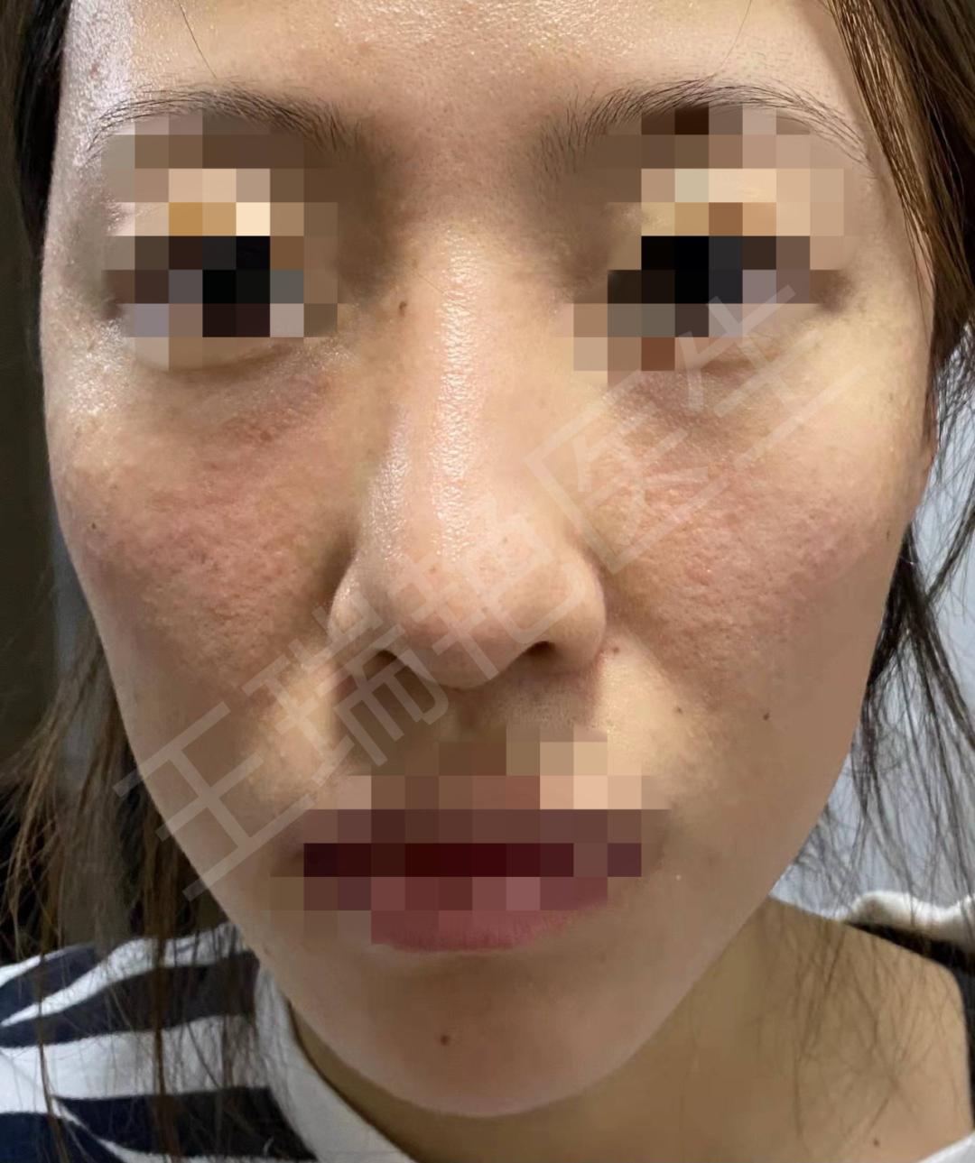 烂脸的警告,烂脸警告