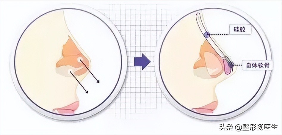 常见的隆鼻方法都有哪些,常见的隆鼻方法有哪几种