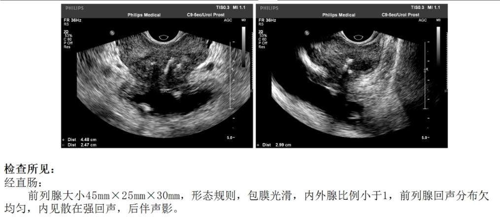 老人患膀胱癌如何减轻痛苦,老人膀胱癌后期太痛苦怎样缓解