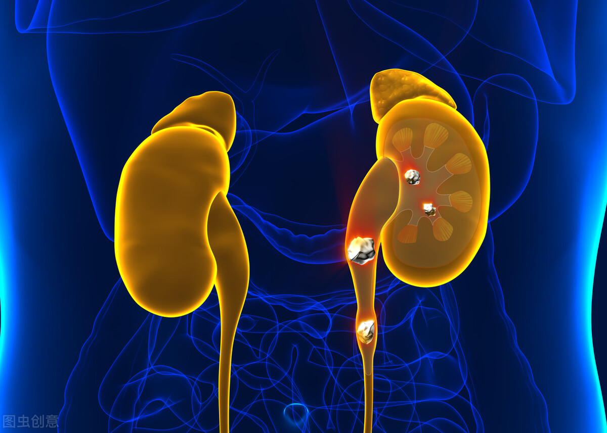 女子长期腰痛一查结石塞满肾脏,女性突然腰痛是不是有结石