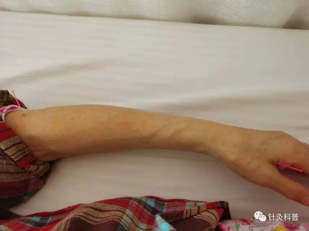 脉诊针灸穴位,董氏针灸治疗青光眼处方