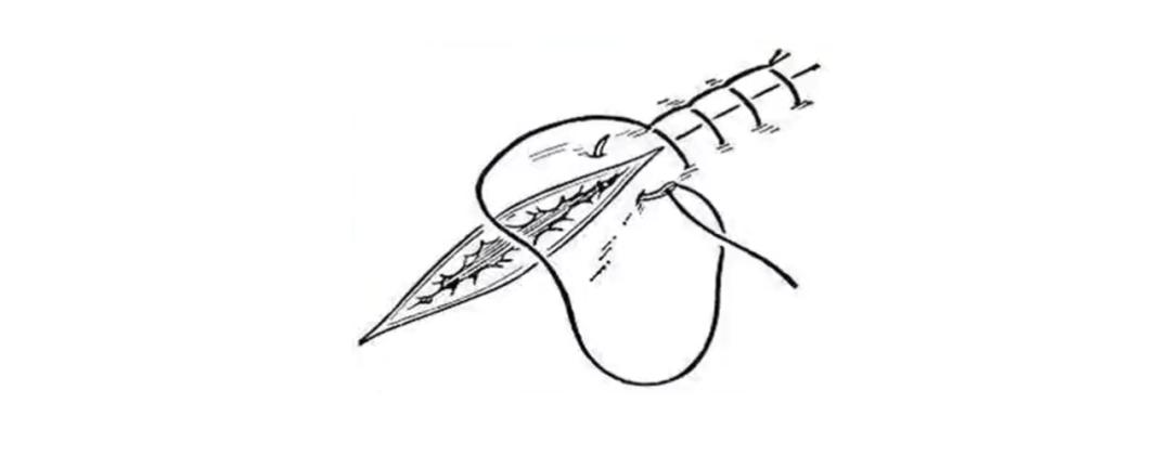 外科缝合技巧你熟练吗,外科缝合术的操作步骤