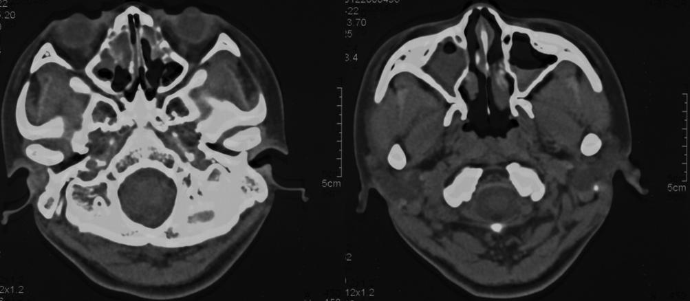 婴儿间断性咳嗽是怎么回事,儿童咳嗽肺部有微小结节有事吗